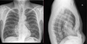 Pectus excavatum deformacija